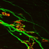 Confocal image of abnormal neuromuscular junctions with innervation by multiple motor neurons. Acetylcholine receptors are red and nerves are green.