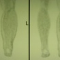Lower extremity lymphedema. 