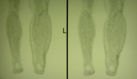 Lower extremity lymphedema. 