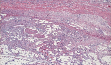 Tumor as viewed through a microscope. 