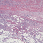 Tumor as viewed through a microscope. 