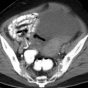 Scan of an ovarian tumor. 