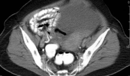 Scan of an ovarian tumor. 