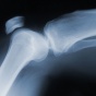 Photo of an x-ray of a knee. 