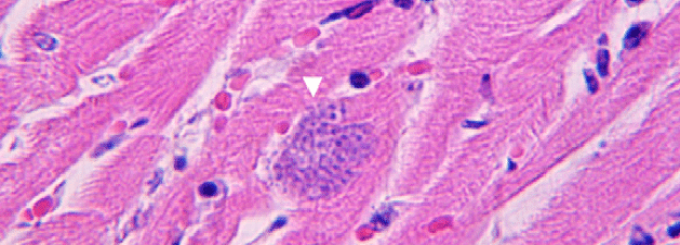 A pink and blue section of heart muscle as seen under a microscope. A cluster of toxoplasma gondii cells infecting the muscle is visible. 