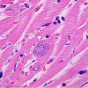 A pink and blue section of heart muscle as seen under a microscope. A cluster of toxoplasma gondii cells infecting the muscle is visible. 