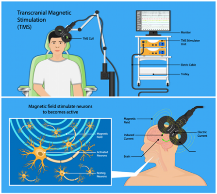 Zoom image: A TMS machine stimulates the brain with electricity. 