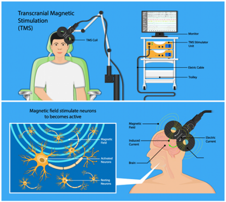 A drawing shows how a Transcranial Magnetic Stimulation machine is held up against a person's head to stimulate specific portions of neurons in a person's brain. 